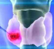 Щитовидната жлеза аденом