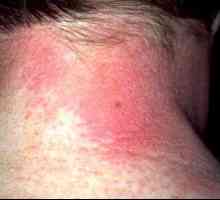 Алергичен дерматит: симптоми и лечение