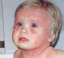 Атопичен дерматит при възрастни и деца