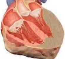 Сърдечна амилоидоза
