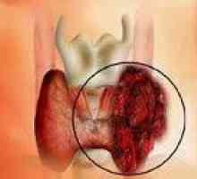 Анапластичен рак на щитовидната жлеза