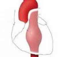 Аневризма на низходящ торакалната аорта
