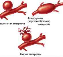 Бъбречната артерия аневризма
