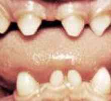 Аномалии на форма зъби