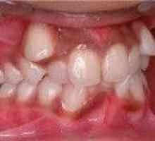 Аномалии на никненето на зъби