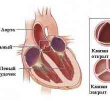 Аортна недостатъчност (аортна клапа)
