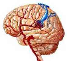 Артериовенозни малформации на мозъка
