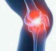 Arthritis на колянната става