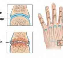 Артритни стави на пръстите на ръцете