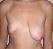 Асиметрия на гърдата