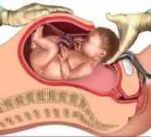 Бременност и раждане с цезарово сечение на матката белег след отстраняването на миома