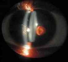 Биомикроскопия очи