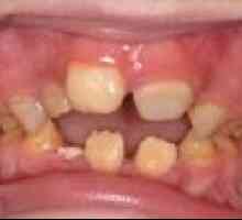 Дефекти на зъбите