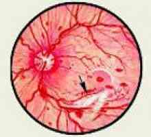 Диабетна ретинопатия