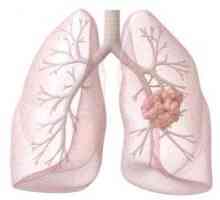 Диагностика и лечение на рак на белия дроб