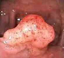 Доброкачествените тумори на дебелото черво