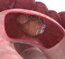 Доброкачествените тумори на тънките черва