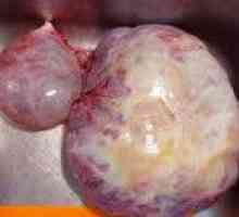 Тумори на зародишни клетки