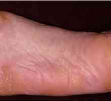 Хиперкератоза на кожата