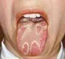 Възпаление на езика