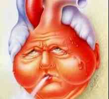 Хронична сърдечна недостатъчност