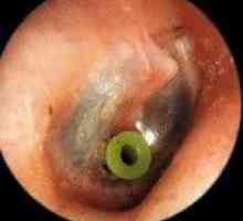 Хронично възпаление на средното ухо с излив