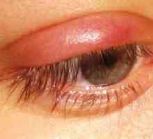 Ечемик на окото: как да се лекува бързо у дома