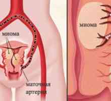 Маточна артерия емболизация (ЕМА), миома на матката