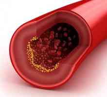 Как да се намали холестерола в кръвта?