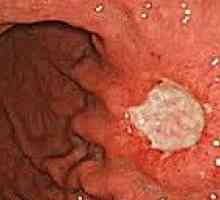 Карциноидни тумори на стомашно-чревния тракт