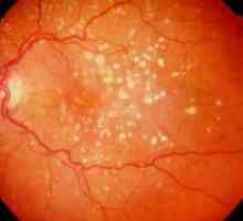 Каротеноидите при лечението на свързана с възрастта макулна дегенерация на ретината