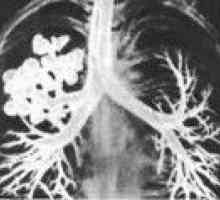 Cystic хипоплазия на белия дроб