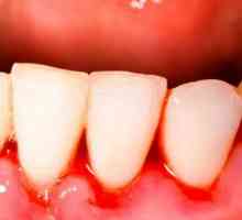 Кървене на венците