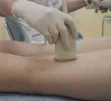 Лечението на тромбофлебит на долните крайници, народни средства за защита