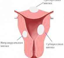Hysteromyoma