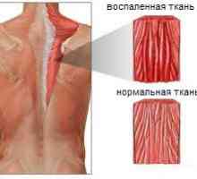 Миозит мускулите на гърба и шията