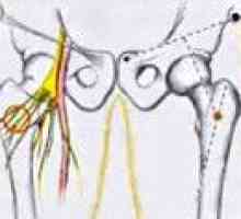 Невропатия бедрената нерв