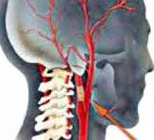Запушване на каротидните артерии