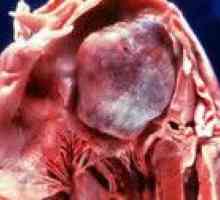 Тумори на сърцето