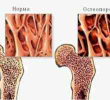 Костен остеопороза