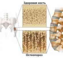 Остеопороза