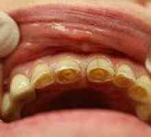 Патологична зъбна абразия