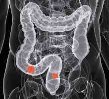 Симптомите на рак на дебелото черво в ранен етап