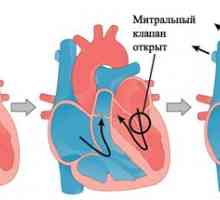 Пролапс на митралната сърдечна клапа