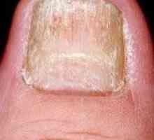 Псориазисът на ноктите на ръцете и краката