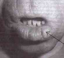 Рак на устните, устната кухина и фаринкса (гърлото)