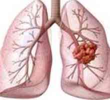 Рак на белия дроб