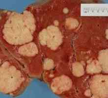 Рак на черния дроб: Симптоми и диагностика