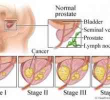 Рак на простатата