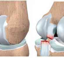 Разликата на сухожилията на коляното кръстни